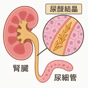 痛風腎