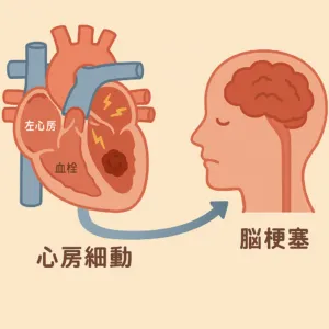 心房細動から脳梗塞