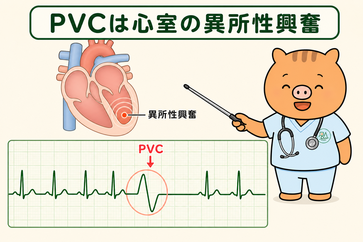 心室性期外収縮（PVC）とは？　脈が飛ぶ・動悸の原因と危険なサインを循環器専門医が解説　（心斎橋・福本医院）