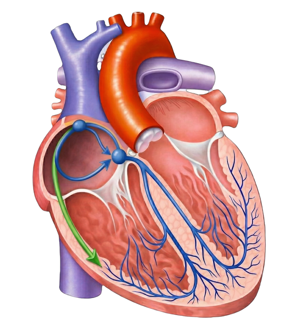 副伝導路(緑色)を伴う心臓の刺激伝導系のイラストで、洞結節・房室結節・ヒス束と副伝導路の位置関係を示した図