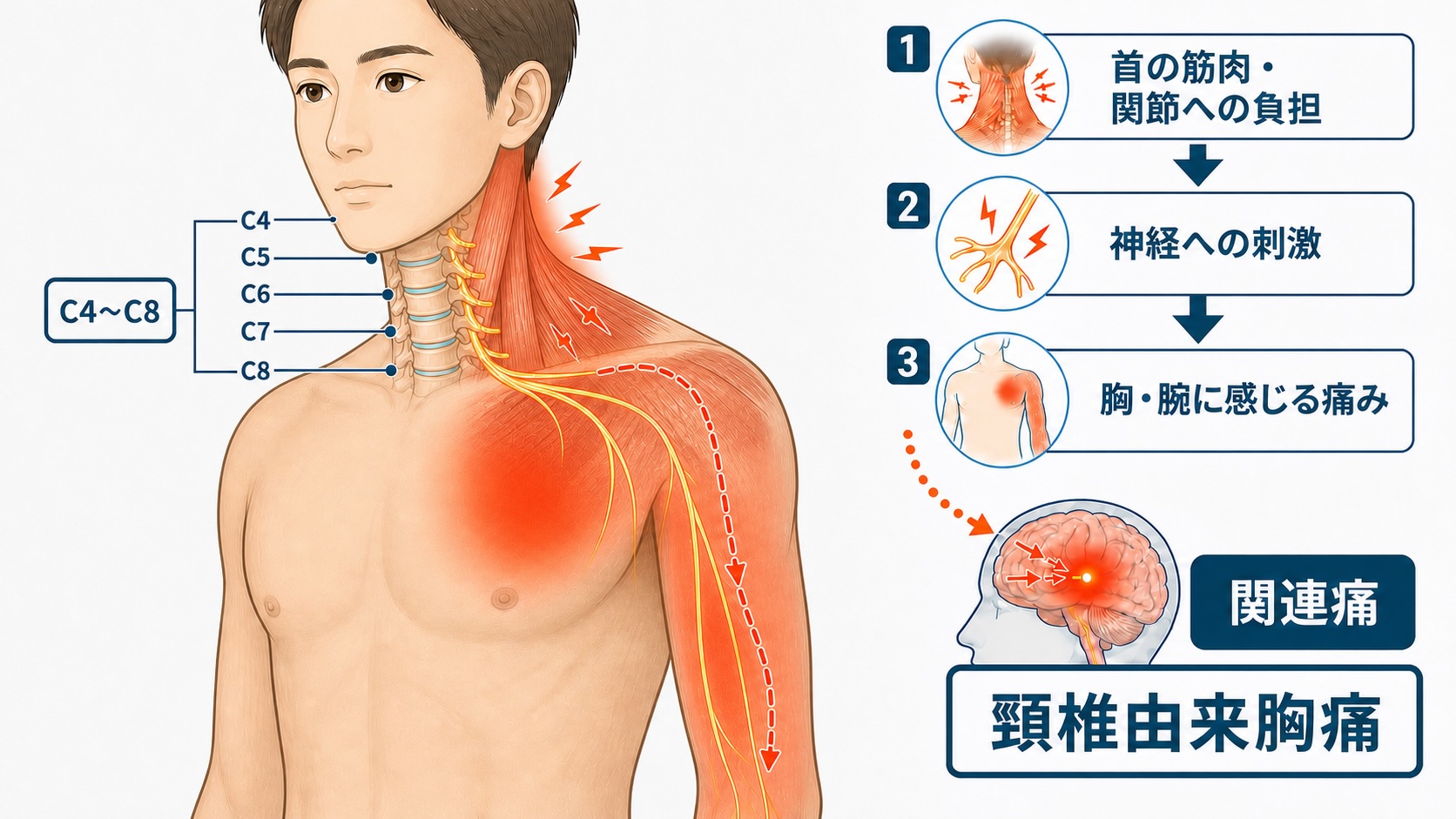 左首・左肩の筋肉の緊張がC4〜C8付近の神経を刺激し、左胸や左腕に関連痛を生じさせる頸椎由来胸痛の模式図