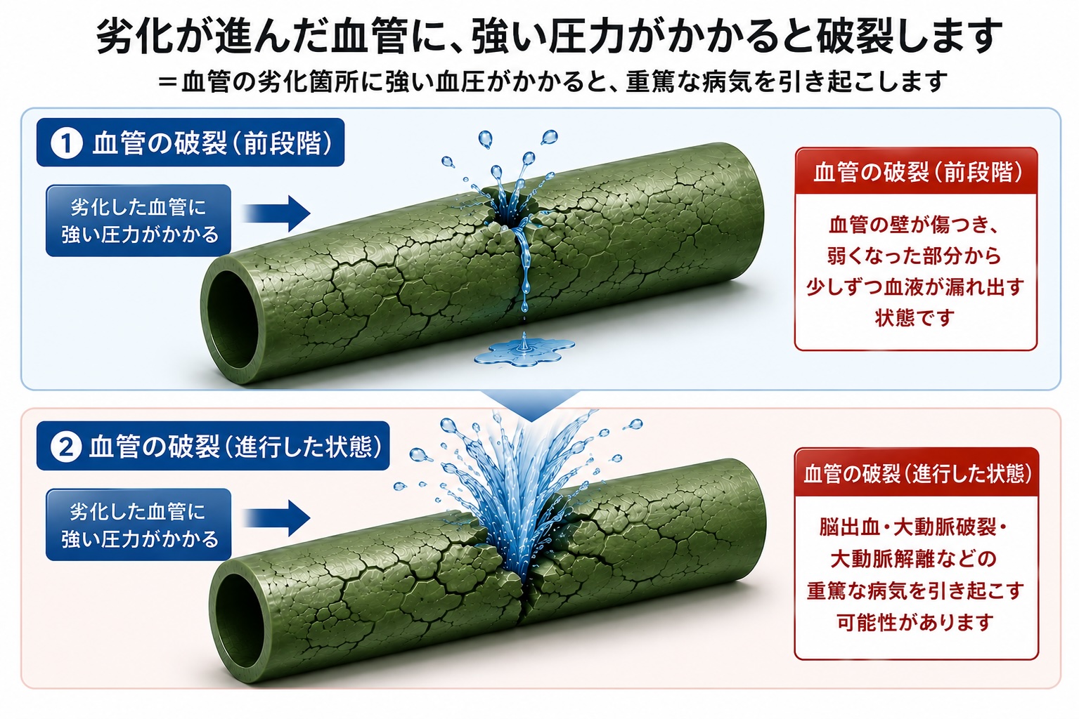 高血圧によって劣化した血管をゴムホースに例えて説明した医療イラスト。上段では血管壁から少しずつ漏水する“破裂前段階”、下段では血管が大きく破裂して大量に水が噴き出す“進行した状態”を比較し、脳出血や大動脈解離など重篤な病気の危険性を表現。