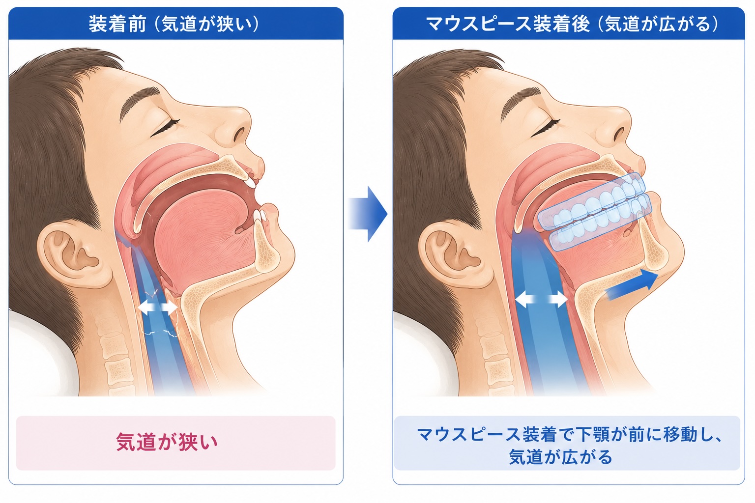 マウスピース装着前後の気道の広がりを比較したイラスト。左は下顎が後方にあり気道が狭くなっている状態、右はマウスピース装着によって下顎が前方へ移動し、気道が広がっている状態を横から示している。