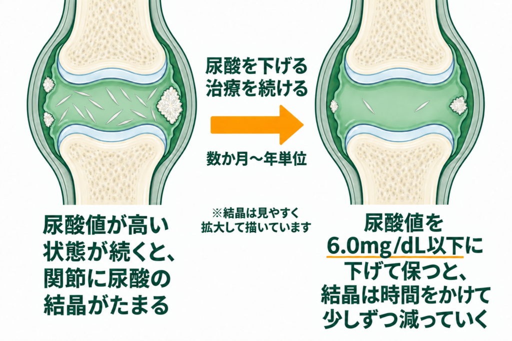 関節に尿酸の結晶がたまった状態と、尿酸値を6.0mg/dL以下に下げて保つことで結晶が時間をかけて小さく少なくなっていく様子を示した模式図。