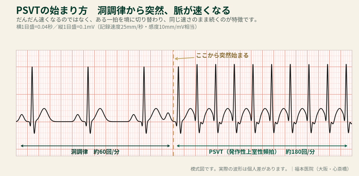 PSVT（発作性上室性頻拍）の始まり方を示す心電図模式図。左側は洞調律で約60回/分、P波・QRS波・T波が規則正しく並ぶ。中央の一拍を境に突然切り替わり、右側はPSVTで約180回/分の速い脈が同じ速さのまま続く。
